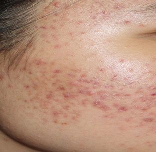 丘疹性痤疮和闭合性粉刺(图3)
